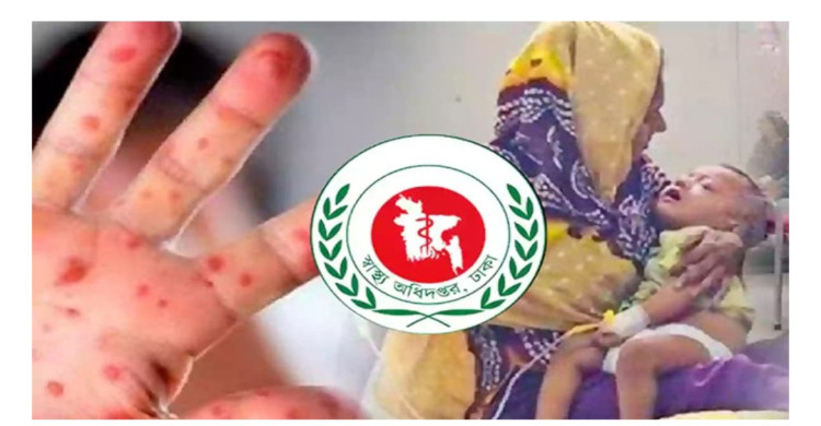 ২৪ ঘণ্টায় হামের উপসর্গে আরও ৫ শিশুর মৃত্যু