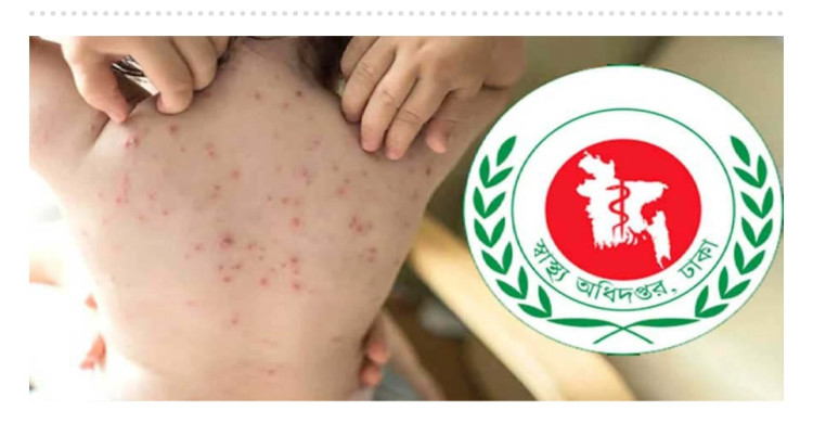 হাম উপসর্গে গত ২৪ ঘণ্টায় ৭ জনের মৃত্যু